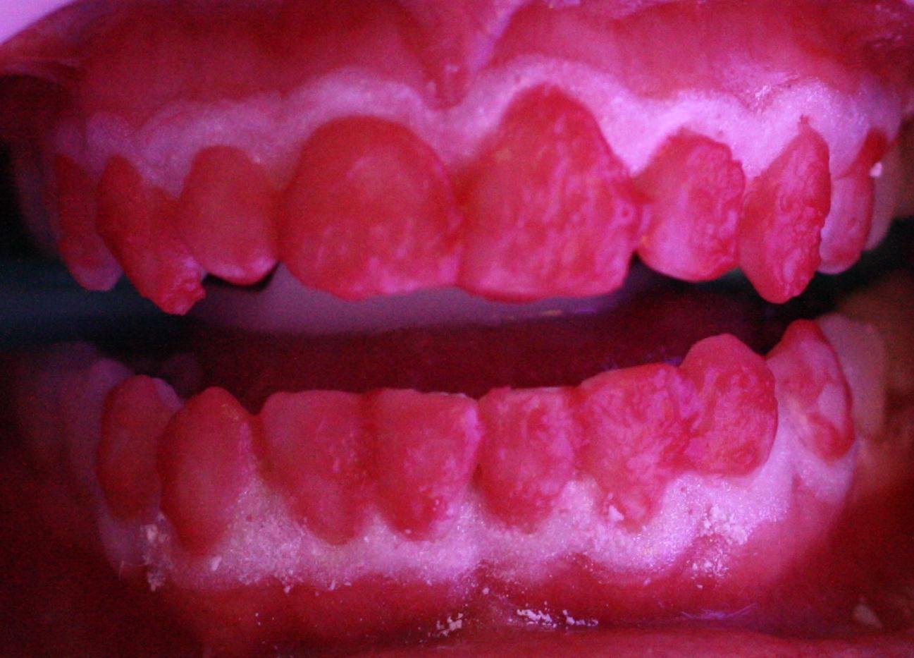 colocaci{on de barrera gingival y aplicacion de gel de peroxido de hidrógeno al 35%