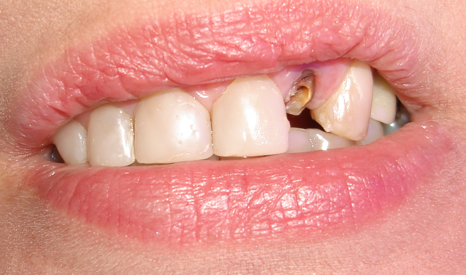 borde Habitual personalidad Qué hacer cuando se nos fractura un diente? -