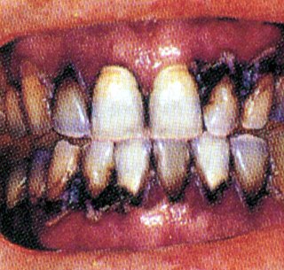 Efectos del cigarrillo electrónico en dientes y encías