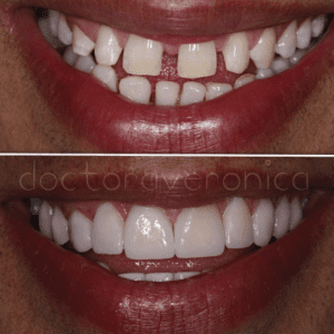 carillas de porcelana antes y despues