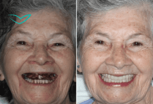 1 implantes dentales consultorio odontologico en bogota