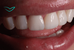 diseño de sonrisa consultorio odontologico en bogota diseño de sonrisa consultorio odontologico en bogota