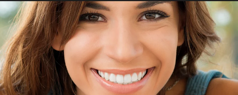 carillas de porcelana