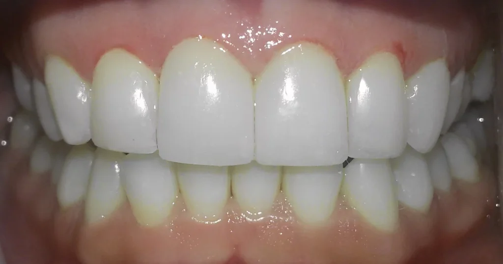 foto carillas despues