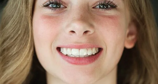 Cuánto dura un Diseño de Sonrisa