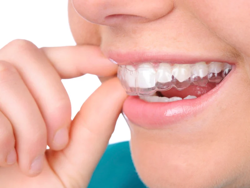 Precio de ortodoncia invisible en Bogotá
