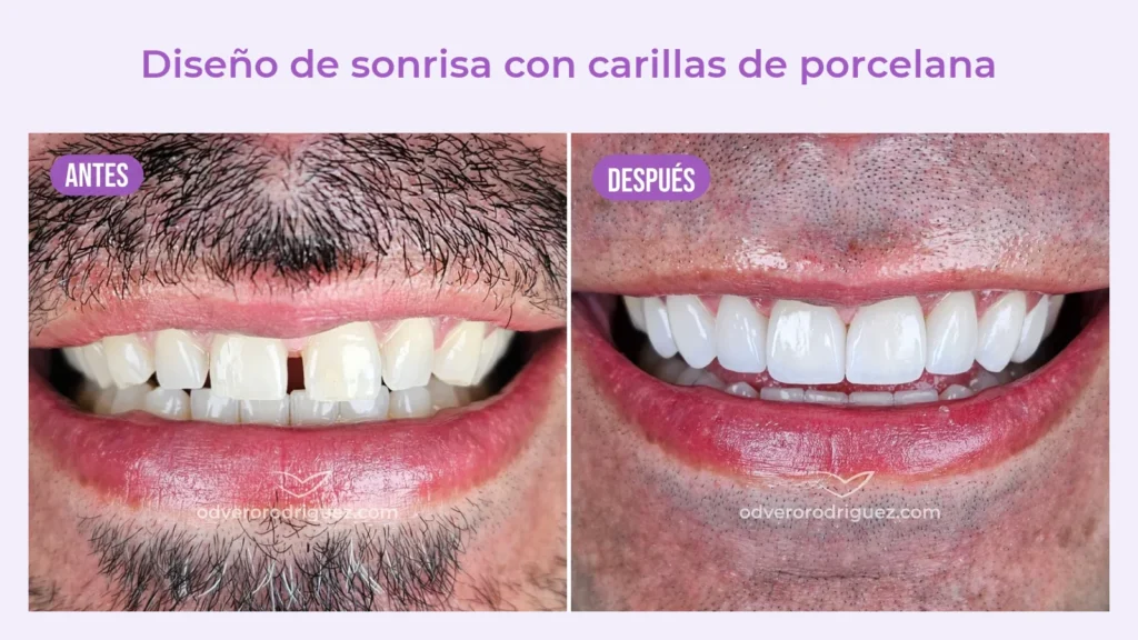 Antes y después de un diseño de sonrisa con carillas de porcelana en Bogotá