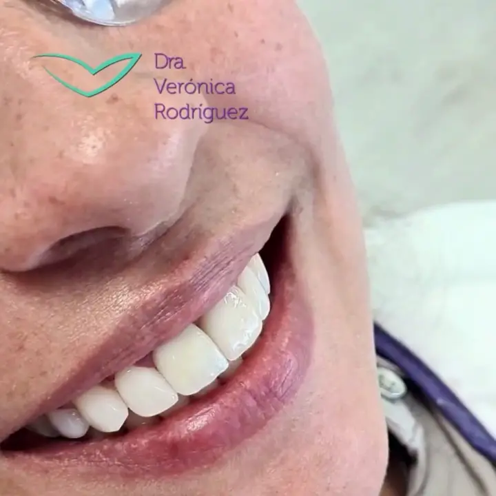 Video: Diseño de sonrisa natural